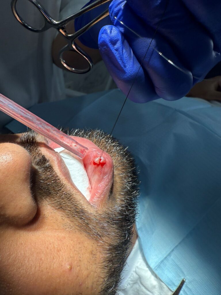 Antes y después de una cirugía de mucocele en el labio inferior realizada en Lanzarote.