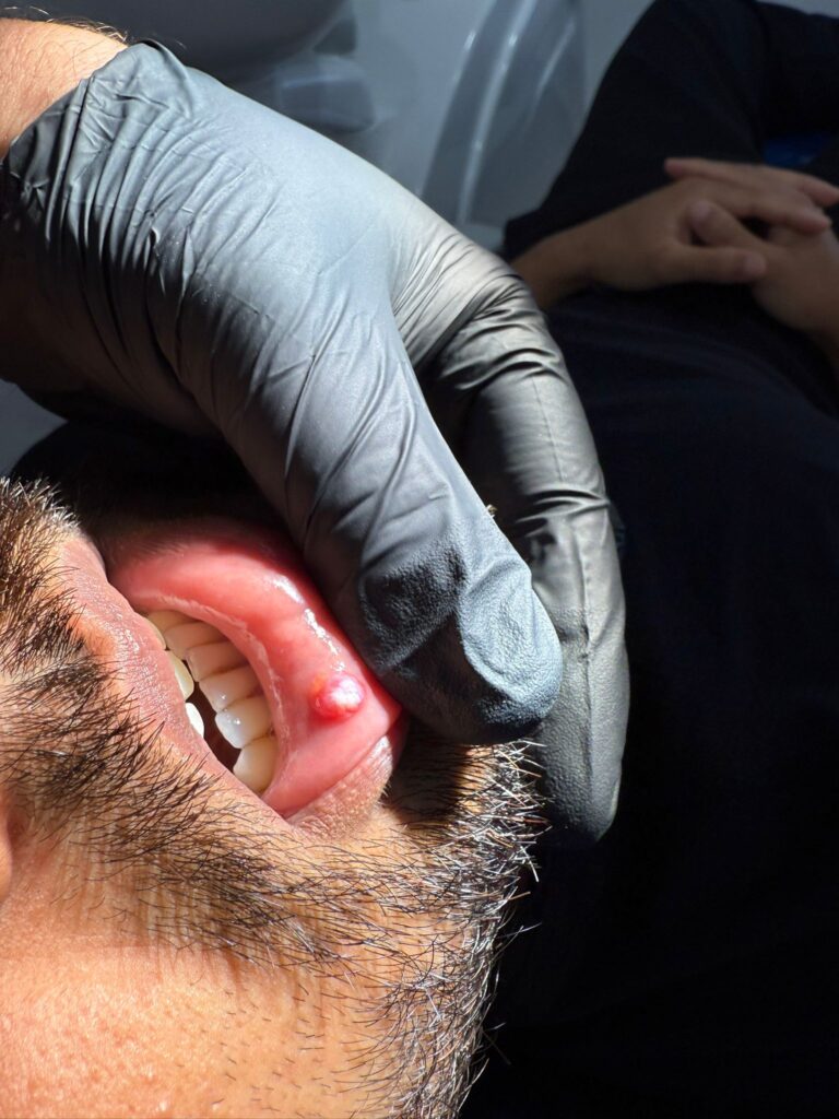 Antes y después de una cirugía de mucocele en el labio inferior realizada en Lanzarote.