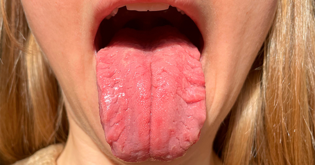 Paciente mostrando los síntomas de una lengua agrietada en la Clínica CEM
